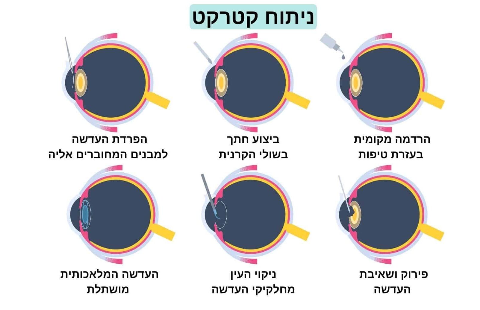 תהליך ושלבים בביצוע ניתוח קטרקט בעין