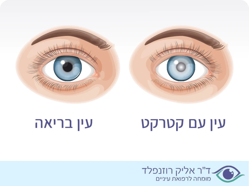 עין עם קטרקט לעומת עין בריאה