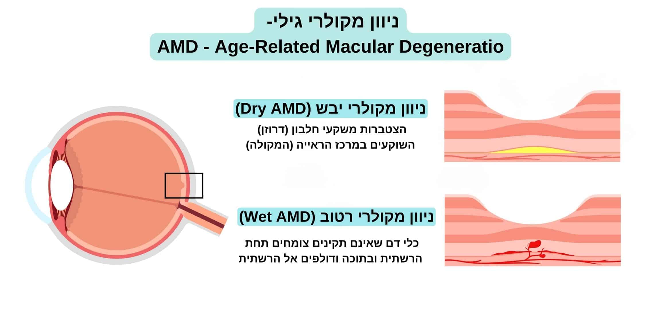 ניוון מקולרי גילי - AMD, דוגמא לניוון מקולרי יבש וניוון מקולרי רטוב