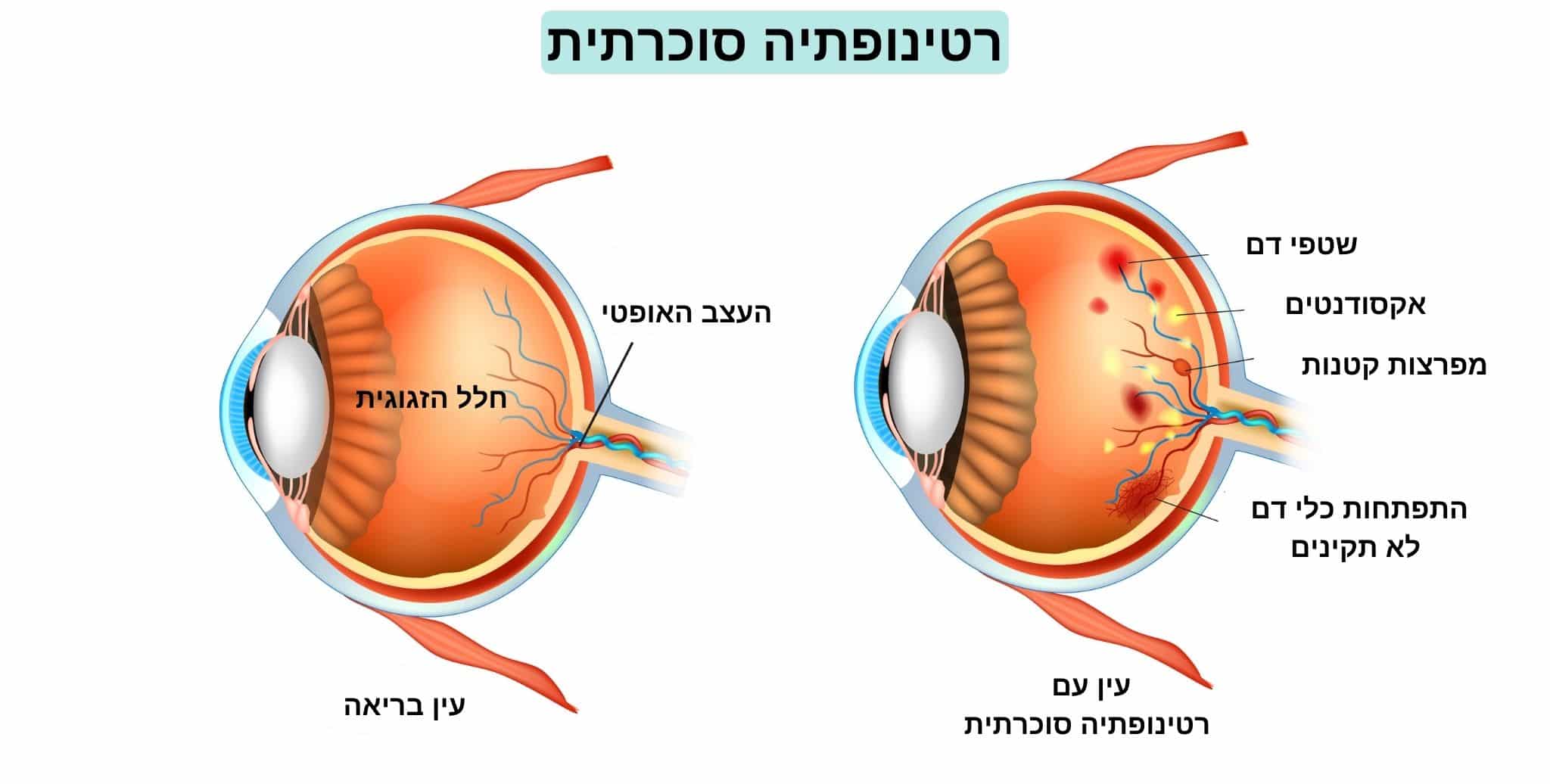 עין בריאה ועין של אדם החולה ברטינופתיה סוכרתית