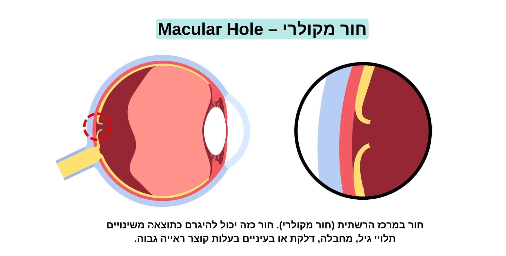 דוגמא לחור במרכז הרשתית - חור מקולרי