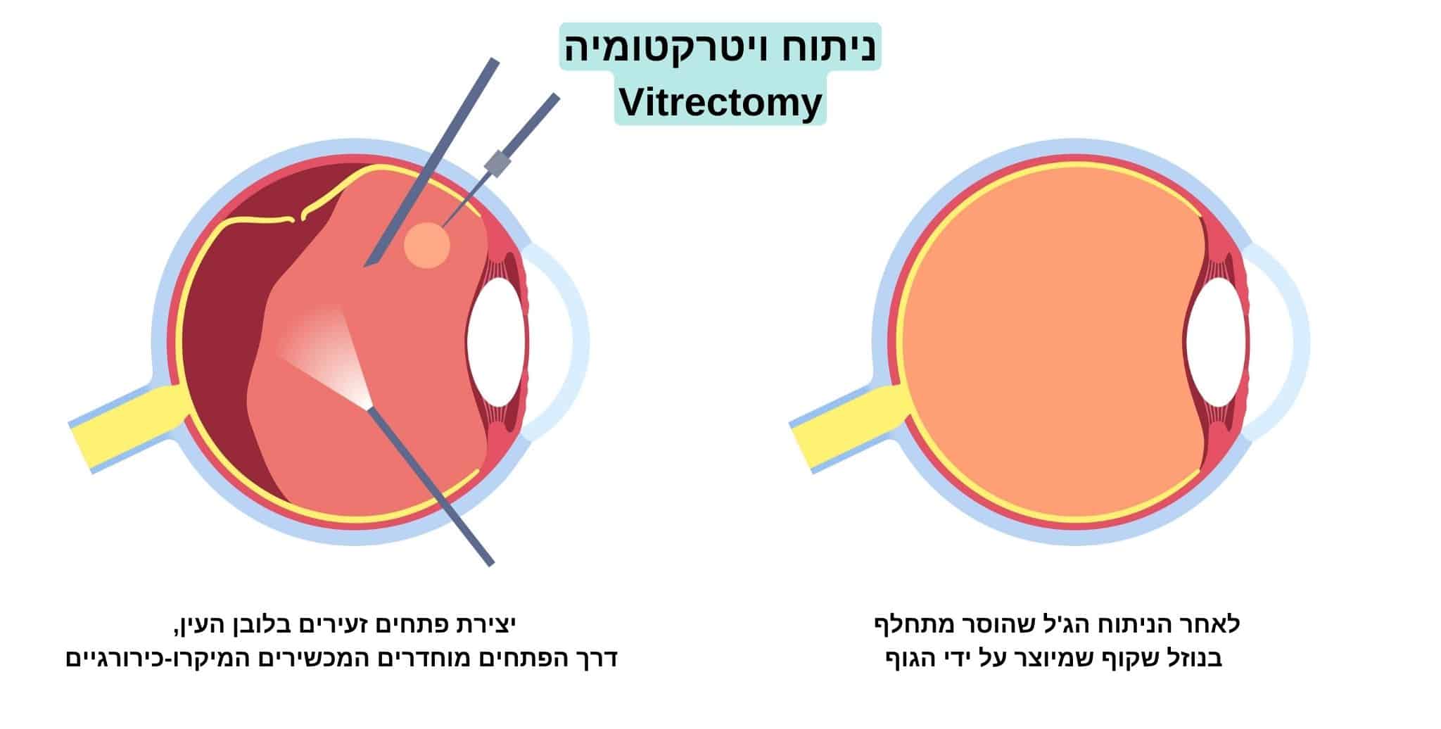 ניתוח ויטרקטומיה, ביצוע 3 חתכים בלובן העין ולאחר מכן עין אשר מילא אותה נוזל שקוף שייצר הגוף