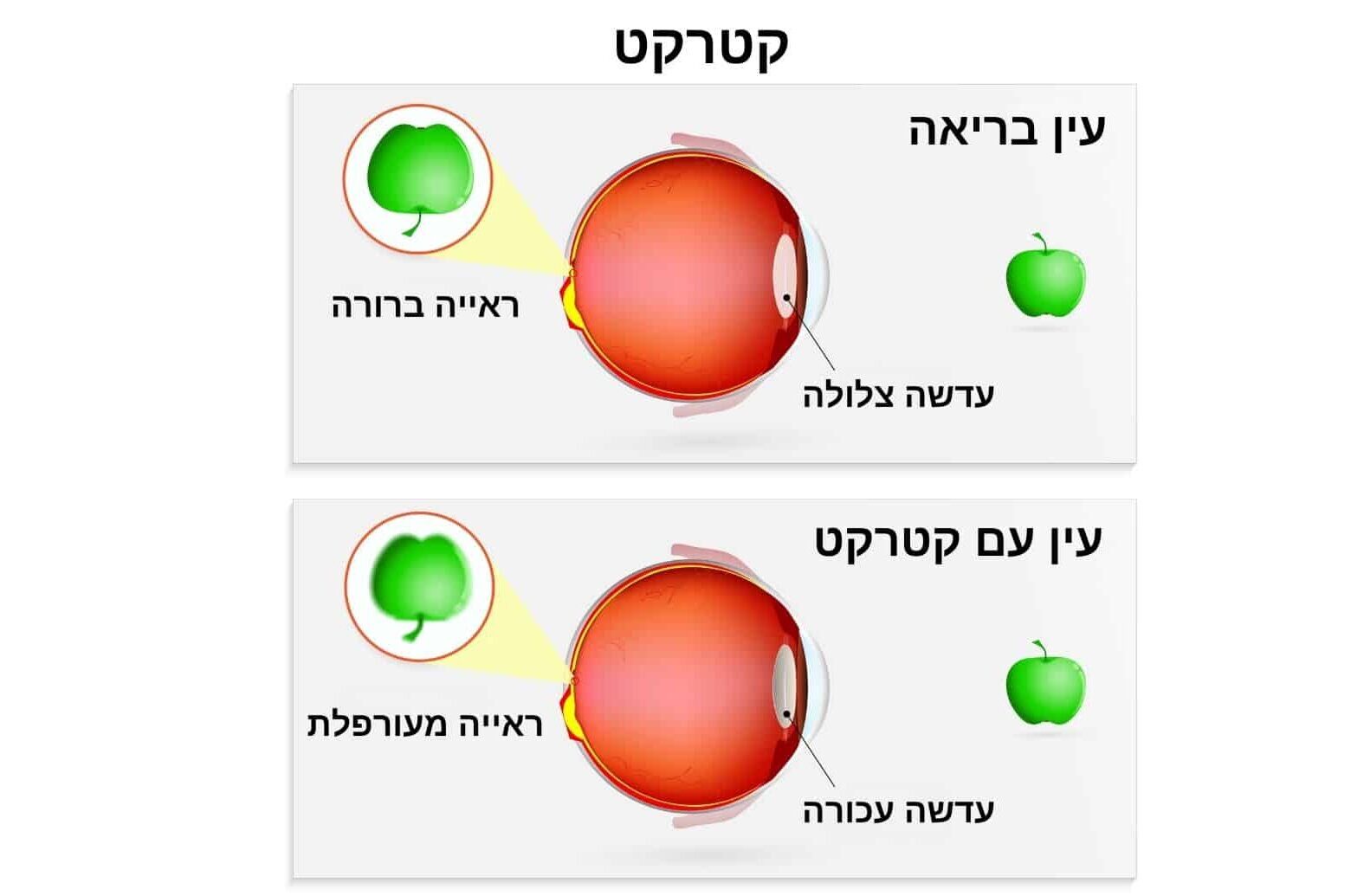 ראייה עם עין בריאה וראייה עם עין בעלת עדשה עכורה עם קטרקט