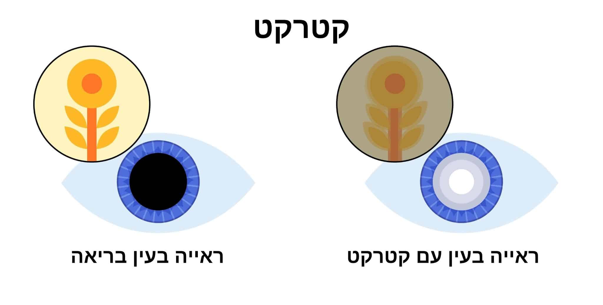 ראייה בעין בריאה וראייה בעין עם קטרקט