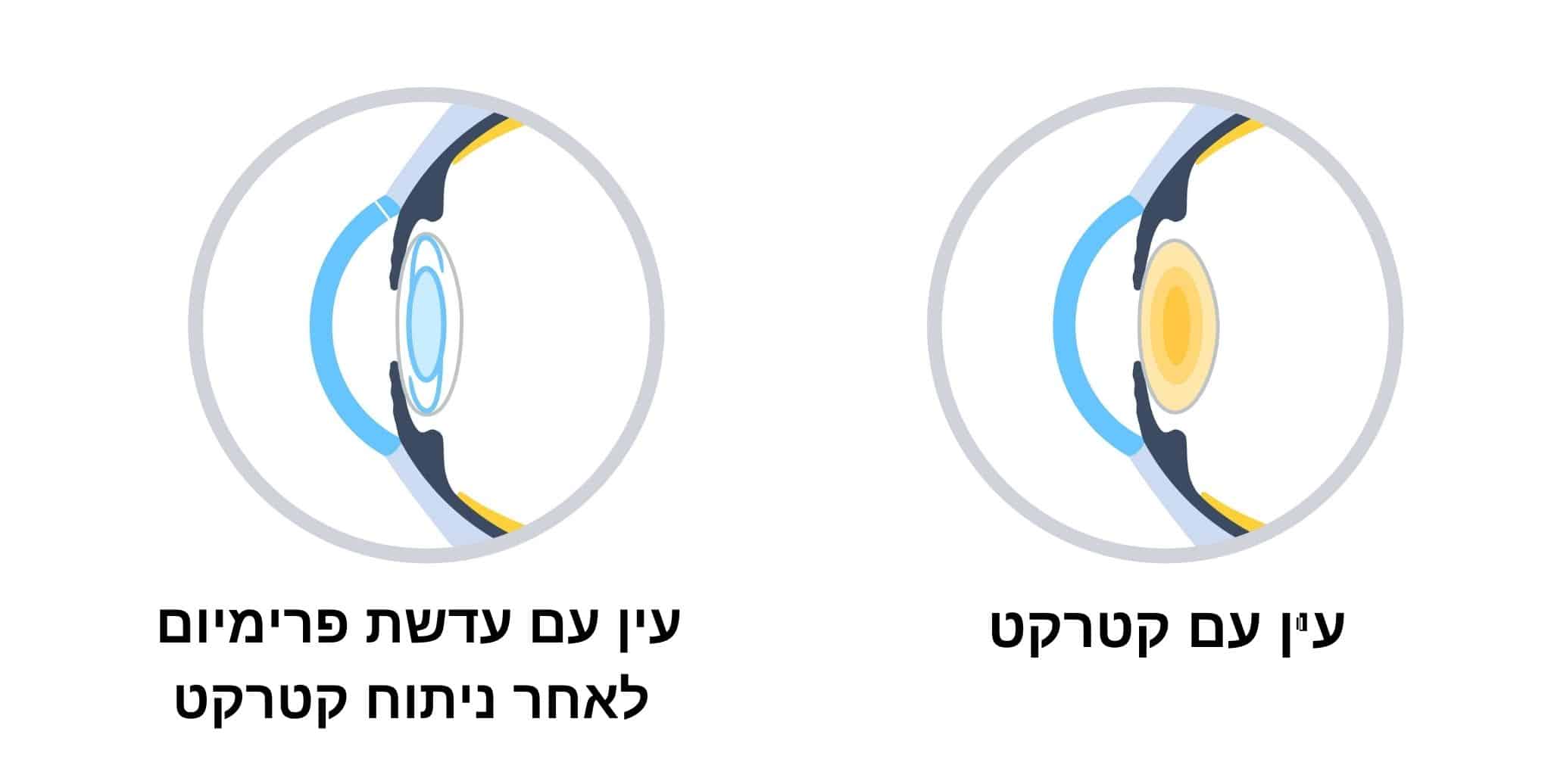 עין עם קטרקט ועין עם עדשת פרימיום לאחר ניתוח קטרקט