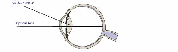 מה זה קטרקט- ד"ר אליק רוזנפלד