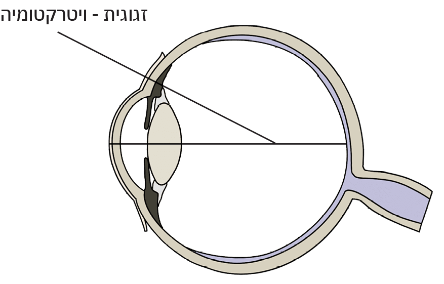 שרטוט של ניתוח ויטרקטומיה