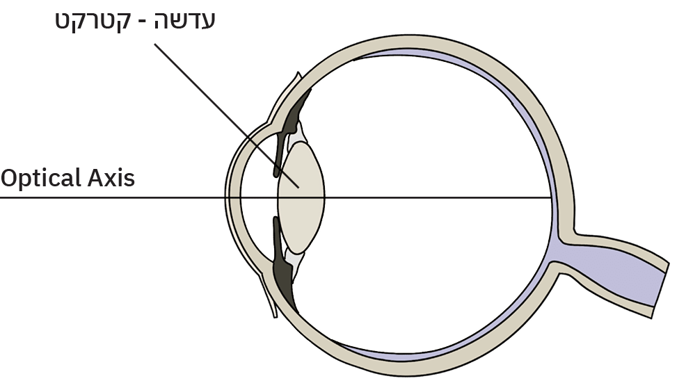 שרטוט של ניתוח קטרקט