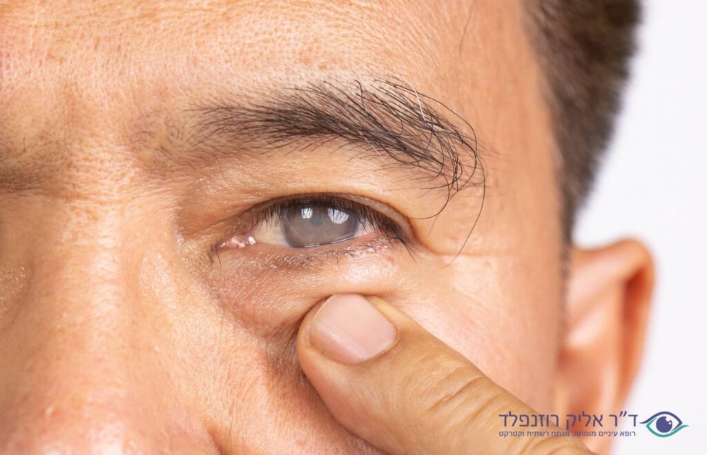 קטרקט לבן קטרקט בשל - דוקטור אליק רוזנפלד